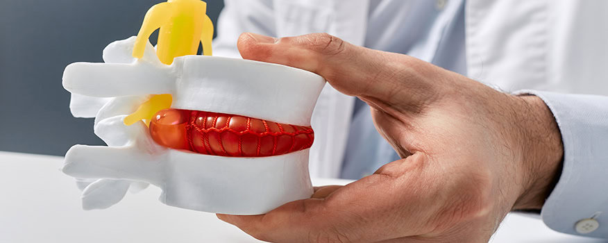 Common Signs of a Herniated Disc Fort Myers