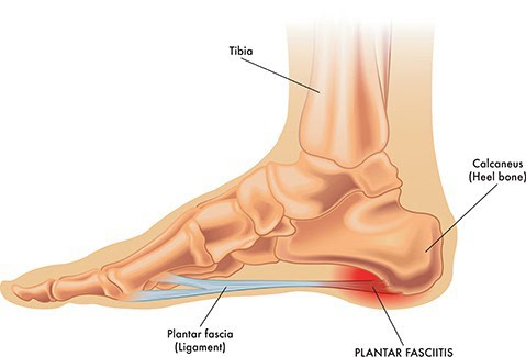 Peripheral Neuropathy Fort Myers